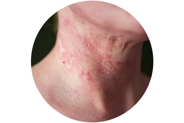 Dermatitis / Eczema