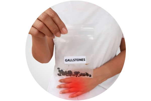 Gallbladder Stone