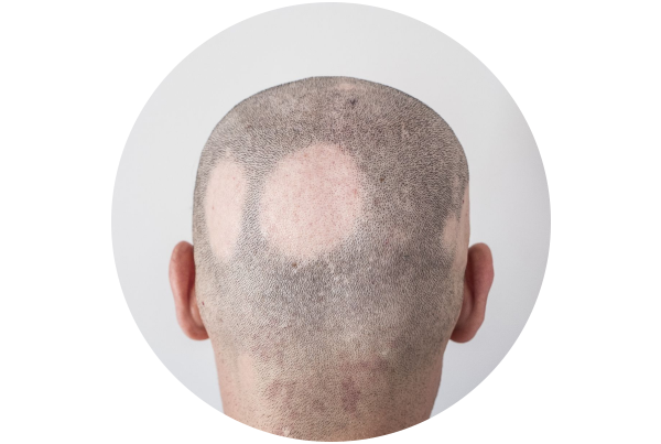 Alopecia Areata