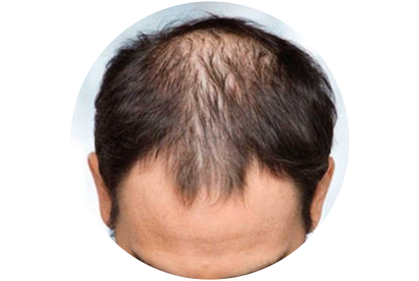 Male Pattern Baldness