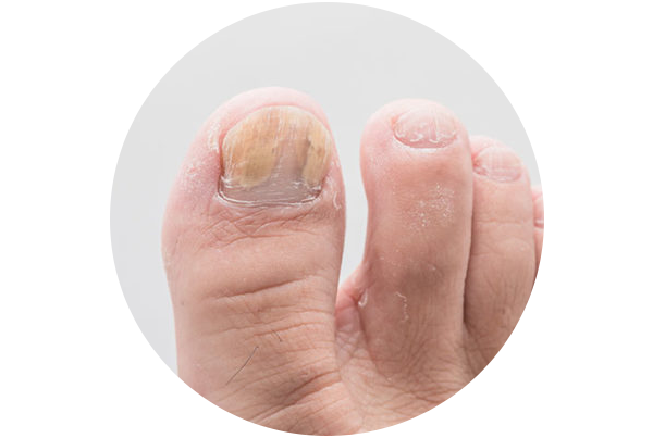 Onychomycosis