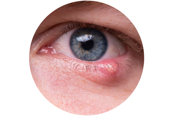 Stye / Chalazion