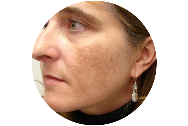 Blemishes / Melasma