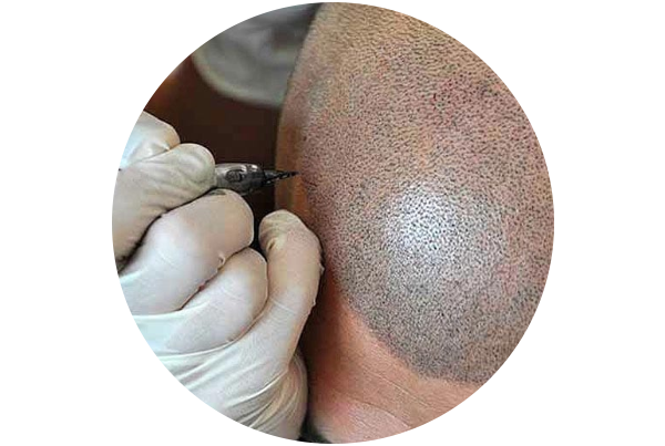 Scalp Micropigmentation