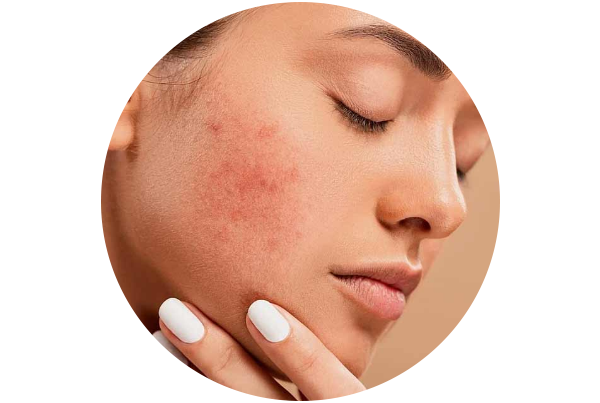 Anti Acne Therapy